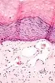 Scrotal angiokeratoma; visible large dilated blood vessels and hyperkeratosis