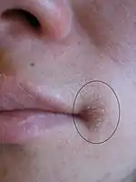 Angular cheilitis