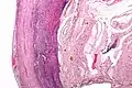 Micrograph of appendicitis and periappendicitis. H&E stain.