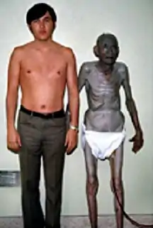 Generalized argyria from using nose drops containing silver. Skin biopsy showed silver deposits in the dermis.