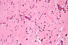 Atrial myxoma. H&E stain.