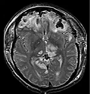 MRI showing damage due to herniation in a patient who had had contusions in the frontal lobes.
