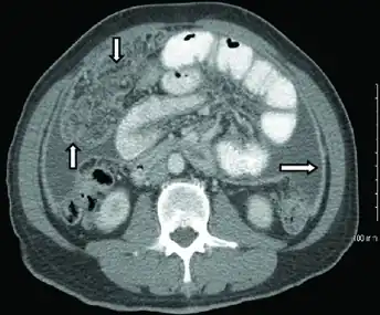 CT scan of peritoneal tuberculosis, a form of extrapulmonary tuberculosis. The omentum and peritoneal surfaces are thickened (arrows).<ref name="AkceBonner2014">.mw-parser-output cite.citation{font-style:inherit;word-wrap:break-word}.mw-parser-output .citation q{quotes:"\"""\"""'""'"}.mw-parser-output .citation:target{background-color:rgba(0,127,255,0.133)}.mw-parser-output .id-lock-free a,.mw-parser-output .citation .cs1-lock-free a{background:linear-gradient(transparent,transparent),url("//upload.wikimedia.org/wikipedia/commons/6/65/Lock-green.svg")right 0.1em center/9px no-repeat}.mw-parser-output .id-lock-limited a,.mw-parser-output .id-lock-registration a,.mw-parser-output .citation .cs1-lock-limited a,.mw-parser-output .citation .cs1-lock-registration a{background:linear-gradient(transparent,transparent),url("//upload.wikimedia.org/wikipedia/commons/d/d6/Lock-gray-alt-2.svg")right 0.1em center/9px no-repeat}.mw-parser-output .id-lock-subscription a,.mw-parser-output .citation .cs1-lock-subscription a{background:linear-gradient(transparent,transparent),url("//upload.wikimedia.org/wikipedia/commons/a/aa/Lock-red-alt-2.svg")right 0.1em center/9px no-repeat}.mw-parser-output .cs1-ws-icon a{background:linear-gradient(transparent,transparent),url("//upload.wikimedia.org/wikipedia/commons/4/4c/Wikisource-logo.svg")right 0.1em center/12px no-repeat}.mw-parser-output .cs1-code{color:inherit;background:inherit;border:none;padding:inherit}.mw-parser-output .cs1-hidden-error{display:none;color:#d33}.mw-parser-output .cs1-visible-error{color:#d33}.mw-parser-output .cs1-maint{display:none;color:#3a3;margin-left:0.3em}.mw-parser-output .cs1-format{font-size:95%}.mw-parser-output .cs1-kern-left{padding-left:0.2em}.mw-parser-output .cs1-kern-right{padding-right:0.2em}.mw-parser-output .citation .mw-selflink{font-weight:inherit}Akce M, Bonner S, Liu E, Daniel R (2014). "Peritoneal tuberculosis mimicking peritoneal carcinomatosis". Case Reports in Medicine. 2014: 436568. doi:10.1155/2014/436568. PMC 3970461. PMID 24715911.