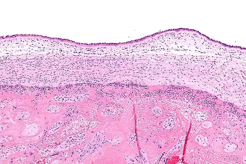Intermediate magnification micrograph of moderate chorioamnionitis.