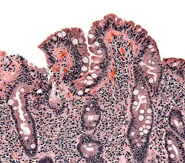 Biopsies of the small bowel in bacterial overgrowth can mimic celiac disease, with partial villous atrophy.