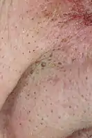 Multiple closed comedones at the nasolabial fold and the alar of the nose