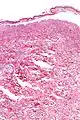 Confluent Epidermal Necrosis, low mag