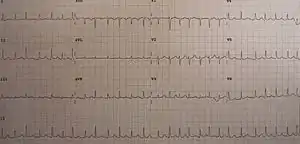An ECG showing sinus tachycardia and electrical alternans in a person with a pericardial effusion.