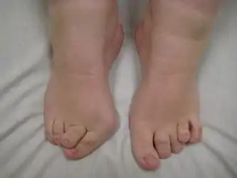 Feet of a person with Larsen syndrome: Note the small size and joint abnormalities.