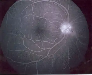 Fluorescein angiography can reveal arteriovenous malformations.
