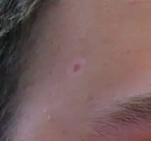 Photograph of a halo nevus on a face