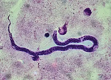 Whole blood with microfilaria worm, giemsa stain