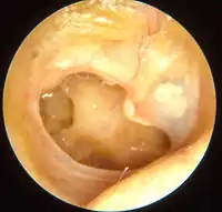 Otitis media chronica mesotympanalis