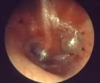 Acute otitis media, myringitis bullosa