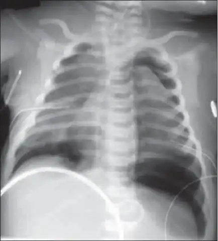 Bilateral pneumothorax seen in the neonate with meconium aspiration