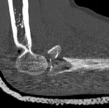 CT scan demonstrating the Mason Type III radial head fracture