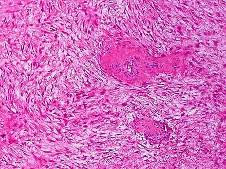 Desmoid fibromatosis, H&E stain. Banal fibroblasts infiltrate the adjacent tissue in fascicles. Mitoses may be infrequent.