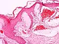 Scrotal angiokeratoma (Fordyce type); dilated cavernous capillaries, acanthosis
