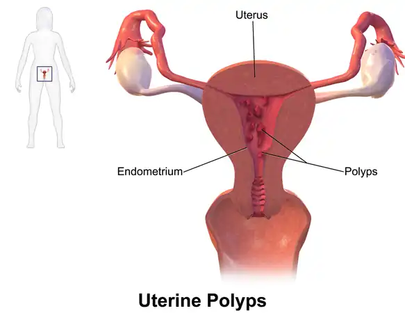 Diagram showing location of polyps