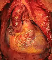 Transplanted heart in the thorax of recipient
