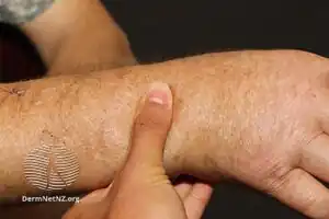 Scleredema (immune)