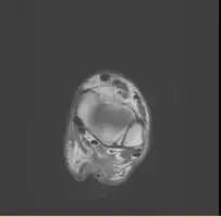 Transverse plane/Achilles tendon rupture