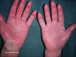 Ichthyosis acquisita