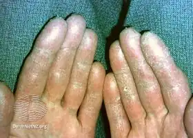 Paraneoplastic acrokeratosis