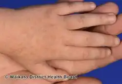 Acrokeratosis verruciformis of Hopf