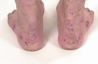 Crusts around the ankles and feet in the same patient as above