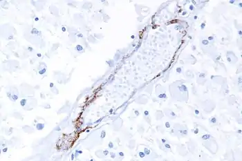 A micrograph showing punctate immunostaining (brown) with a Notch 3 antibody, as is characteristic in CADASIL.