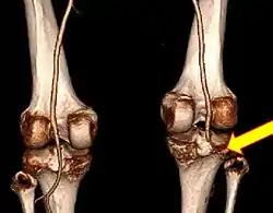 CT angiogram 3D reconstruction, posterior view showing a normal artery on the left, and occlusion to right popliteal artery as a result of a knee dislocation