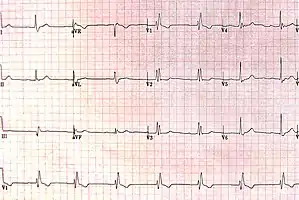 RBBB