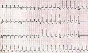 RBBB with associated tachycardia