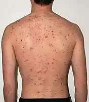 The back of a 30-year-old male after 5 days of the rash
