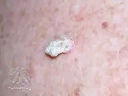 Cutaneous horn