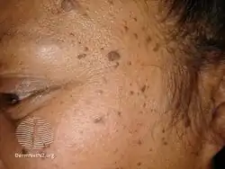 Dermatosis papulosa nigra
