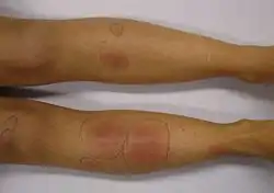 Erythema nodosum in a person who had recently had streptococcal pharyngitis