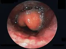 Swollen epiglottis in laryngoscopy