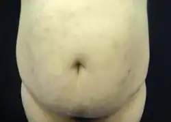 Erythema Dyschromicum Perstans