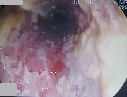 A severe case of candidiasis