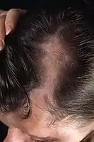 Frontal linear scleroderma