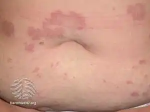 Granuloma annulare