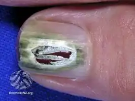 Green nail due to pseudomonas infection