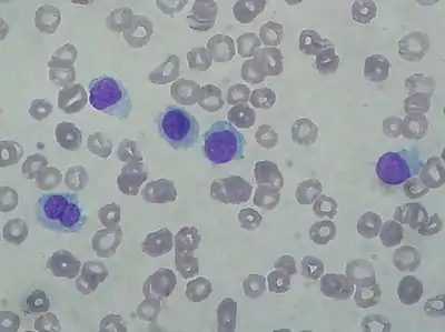 Hairy cell leukemia: Abnormal B cells look "hairy" under a microscope because of radial projections from their surface.