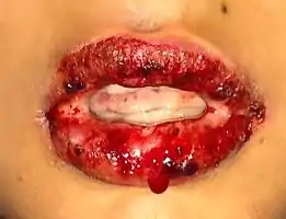 Stevens–Johnson syndrome