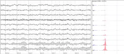 Human EEG with prominent alpha-rhythm