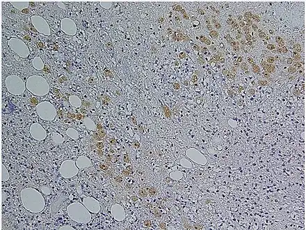 Immunohistochemical staining of trophozoites (brown) using specific anti–Entamoeba histolytica macrophage migration inhibitory factor antibodies in a patient with amebic colitis.