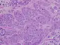 High-grade invasive ductal carcinoma, with minimal tubule formation, marked pleomorphism, and prominent mitoses, 40x field.