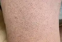 Keratosis pilaris on lower leg